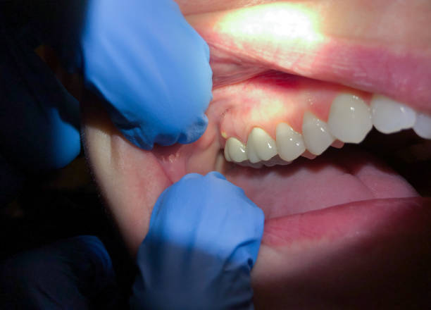 Best Emergency Dentist for Lost Fillings or Crowns in Harrison, MI