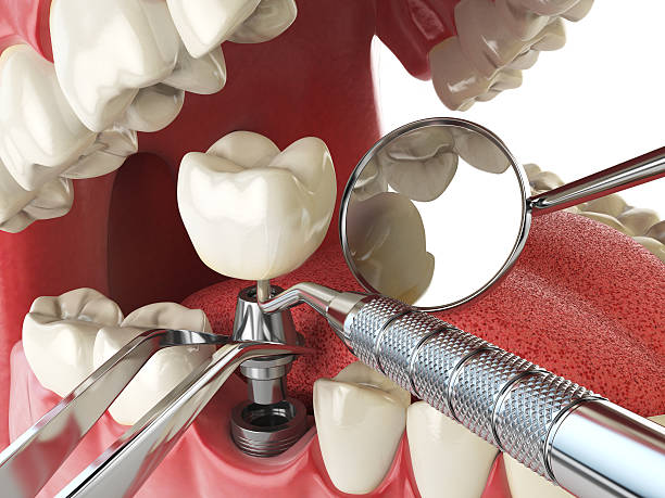 Best Emergency Root Canal Treatment in Harrison, MI